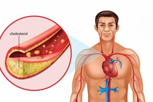 لا تتجاهلها.. علامات خطيرة في ساقيك تكشف أن الكوليسترول أصبح قاتلاً