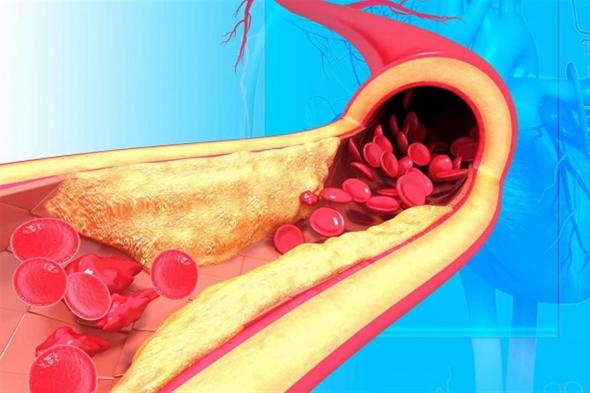 هذا ما يحدث عند تجاهل أعراض ارتفاع الكوليسترول دون علاج.. 6 حيل تقي من مخاطره