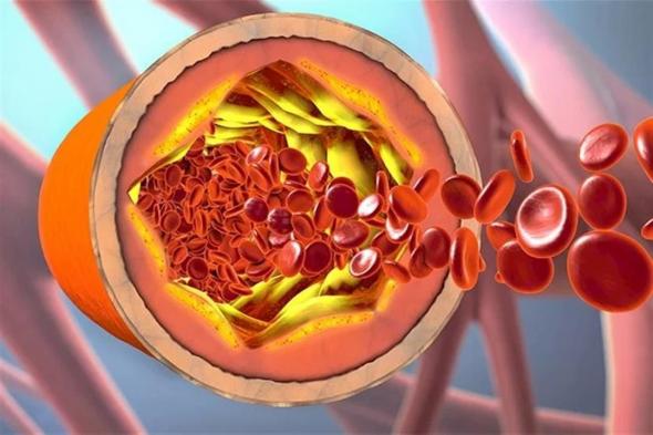 علامة غريبة تستطيع شمها تكشف ارتفاع الكوليسترول في الدم