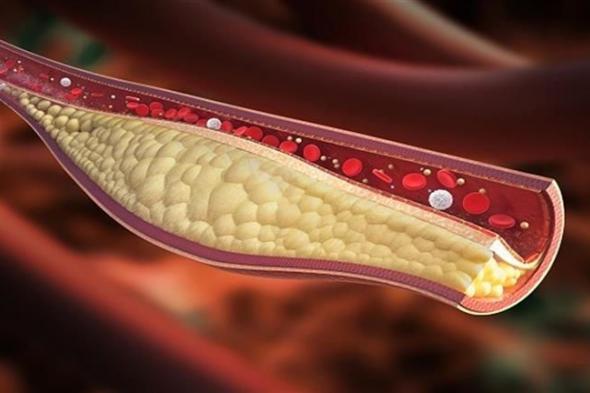 علامة واحدة تكشف انخفاض الكولسترول بالجسم.. تظهر في الصباح
