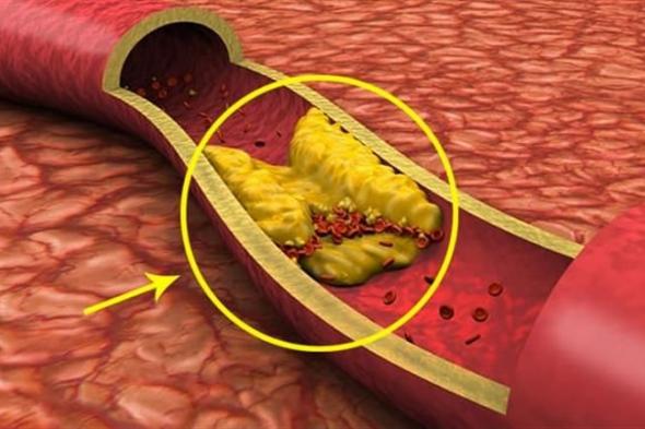 أطعمة ومشروبات "يحبها الدماغ" وتعالج انسداد الشرايين