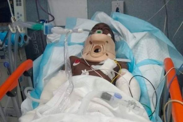 وفاة طفل متأثرا بجراحه بعد يومين من إصابته بانفجار لغم حوثي في حجة