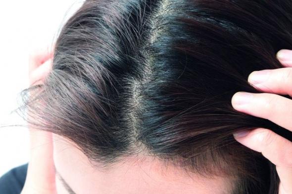 الامارات | مرضى يعالجون مشكلات الشعر بـ «المنشطات».. وأطباء يحذّرون من مخاطرها