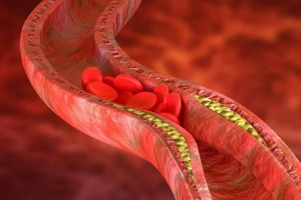 7 أشياء غير متوقعة تسبب ارتفاع الكوليسترول الضار في الدم