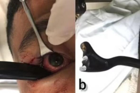الامارات | عملية جراحية في عين رجل لإخراج مقبض الفرامل