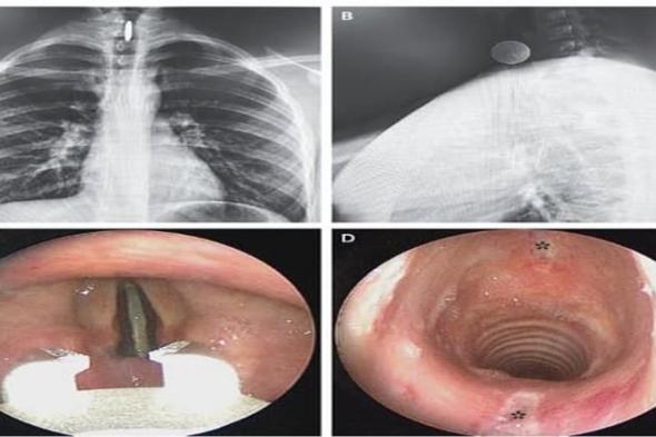 مراهق ينجو بمعجزة بعد ابتلاع عملة معدنية علقت بين أحباله الصوتية