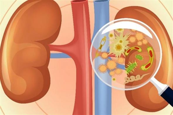 طبيبة تكشف عن الأسباب الرئيسية لتكوين حصى الكلى
