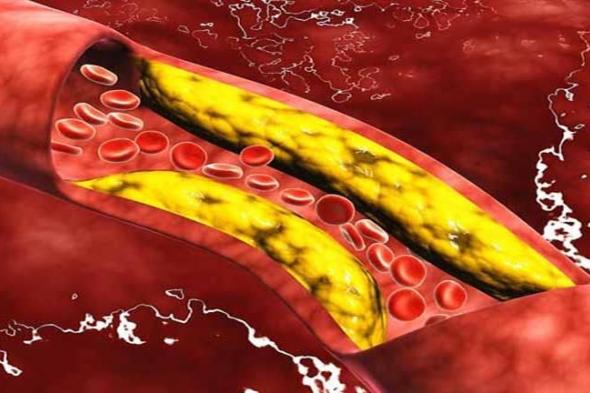 علامة تظهر على اليدين تنذرك بإرتفاع الكوليسترول بالدم