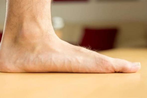 ما أسباب وأعراض الأقدام المسطحة؟