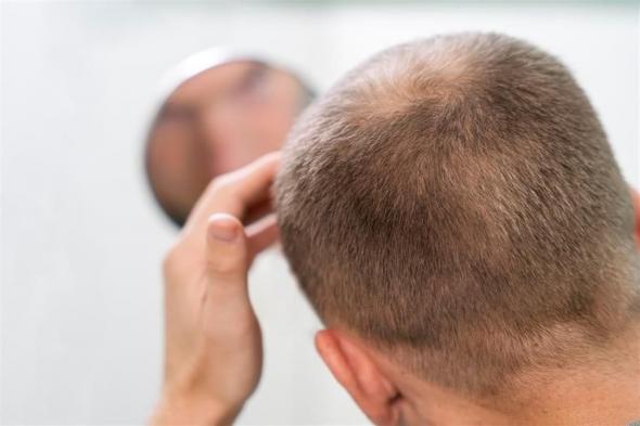 أمل جديد للوصول إلى علاج لتساقط الشعر بعد اكتشاف السبب الدقيق